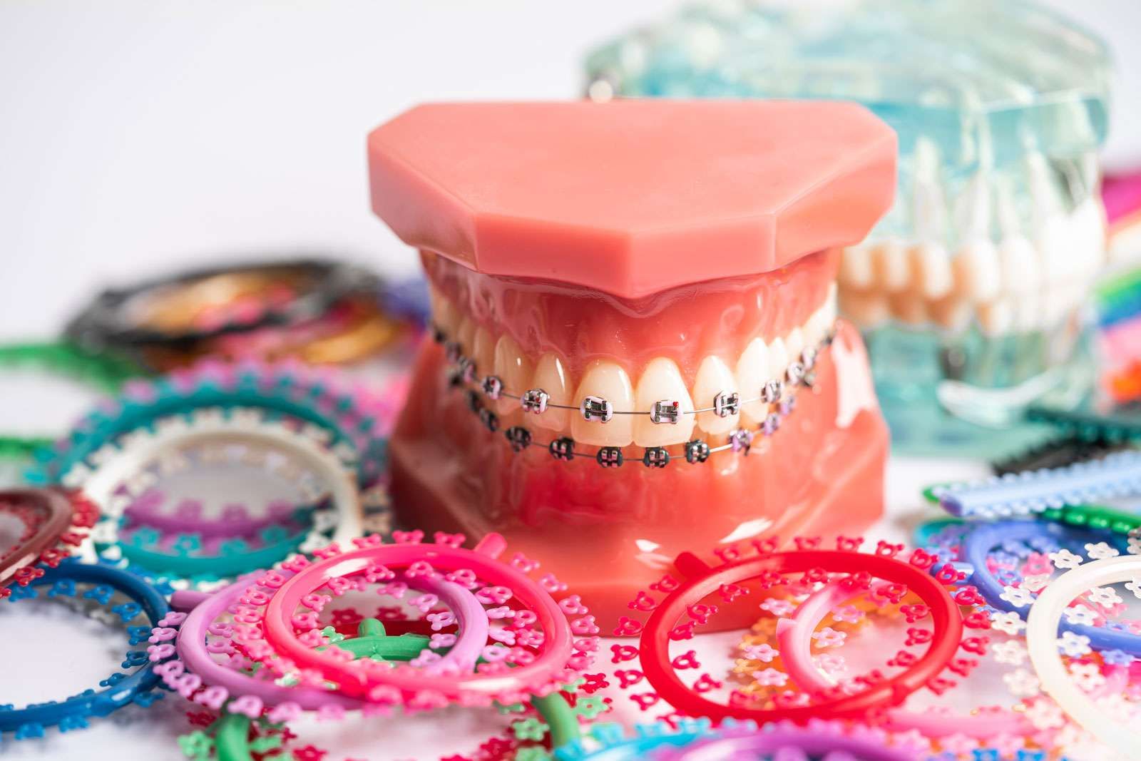 Scopri la varietà degli apparecchi ortodontici dello Studio dentistico Fabbri 1 Gli apparecchi ortodontici sono tutti uguali?