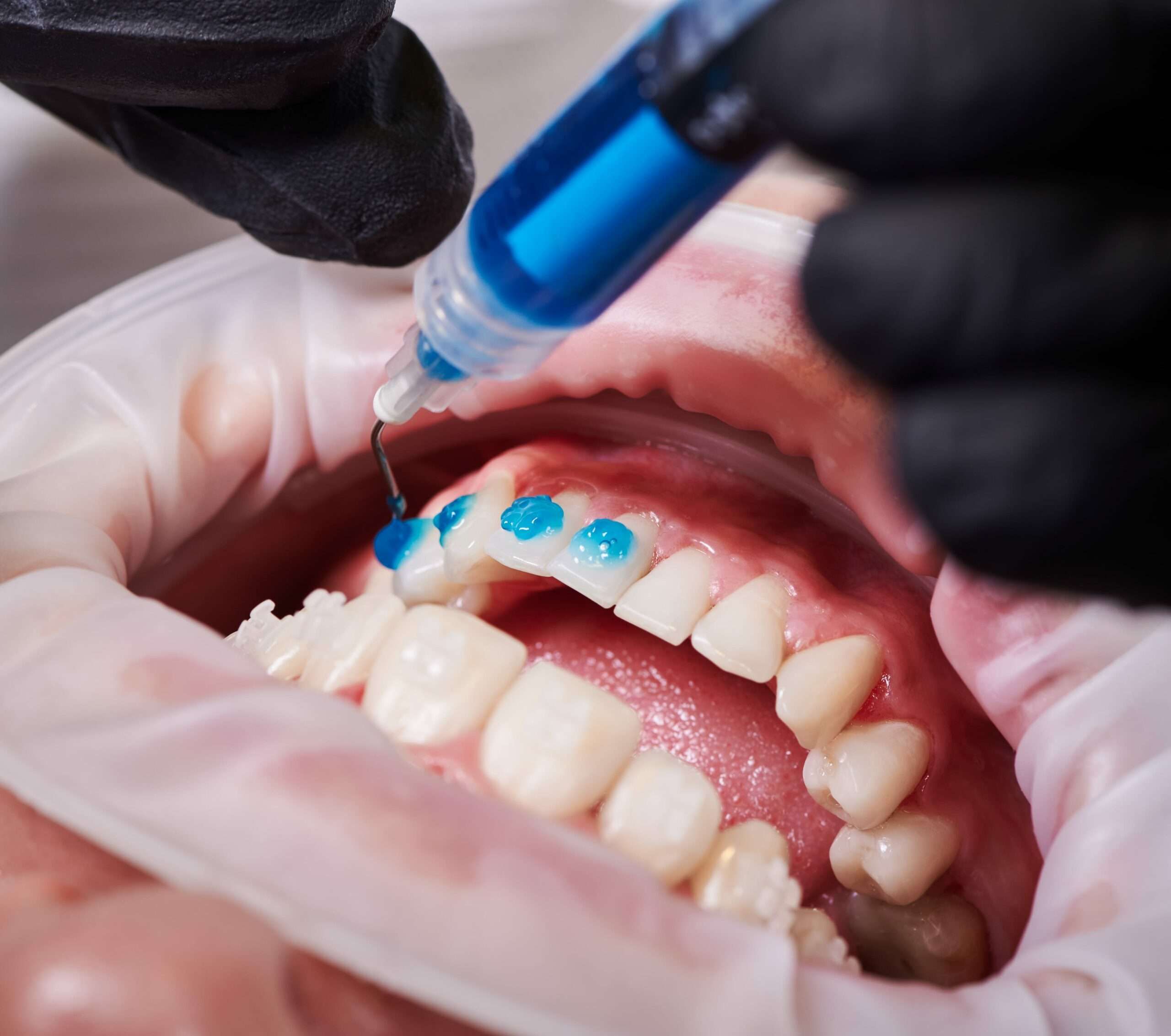 Cos'è la sigillatura dei denti? 1 sigillatura dei denti