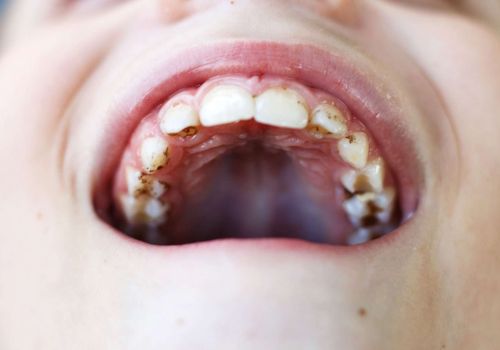 Comprendere le cause delle macchie dentali