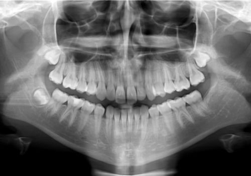 il Sorriso è Servito 3 Hai già fatto una panoramica dentale?