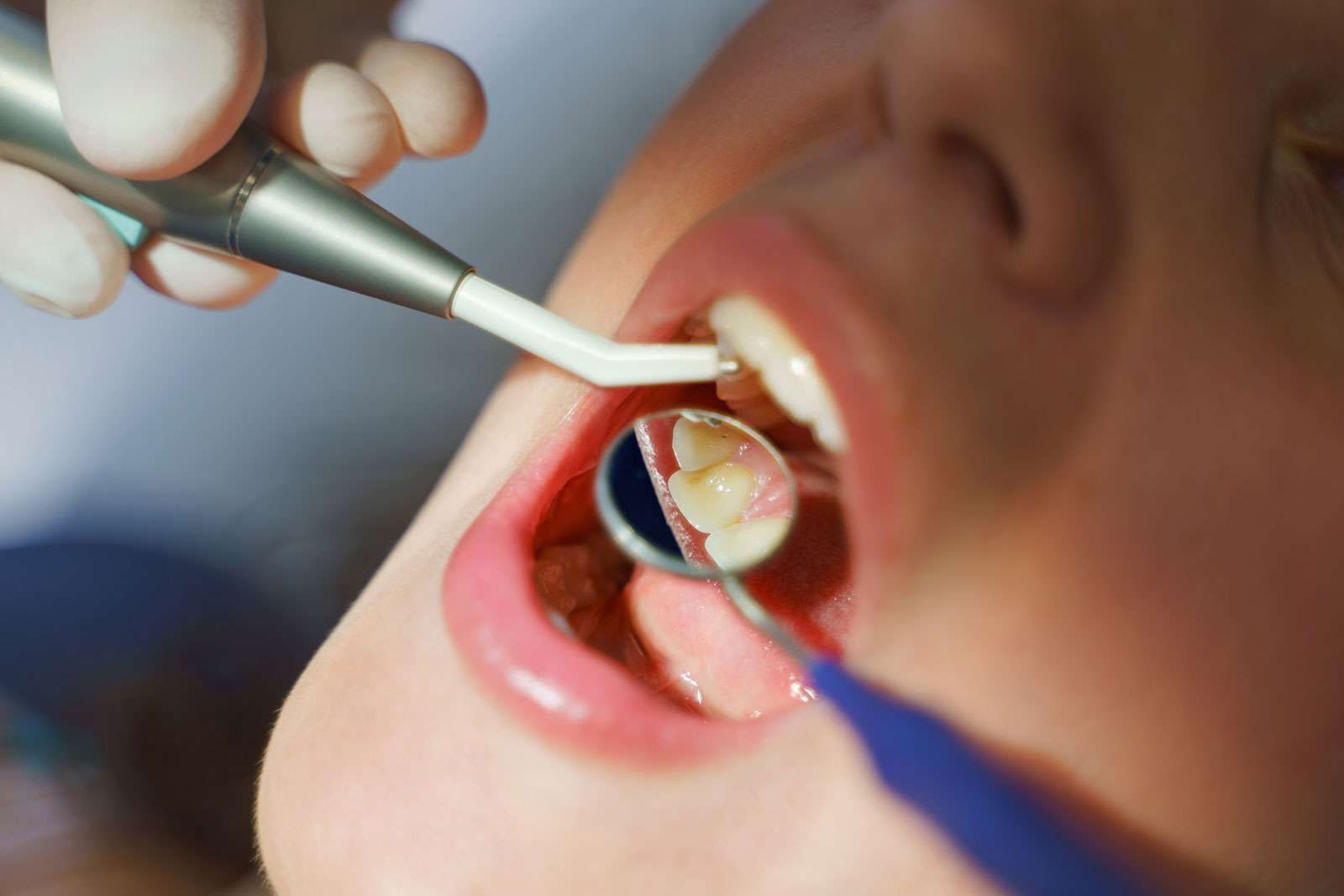 Durata di un dente devitalizzato: cosa aspettarsi 1 Se il dente è devitalizzato prima o poi cadrà?